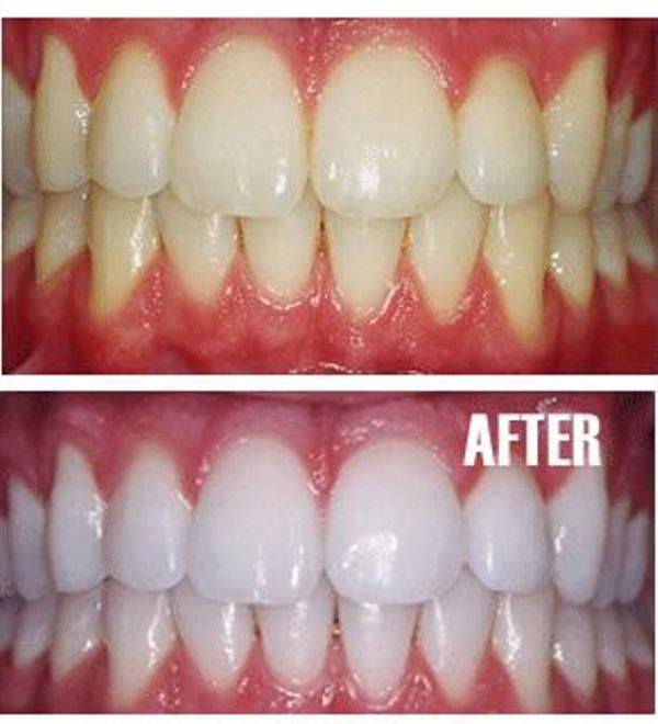 How to Make your Teeth White in a Natural Way?